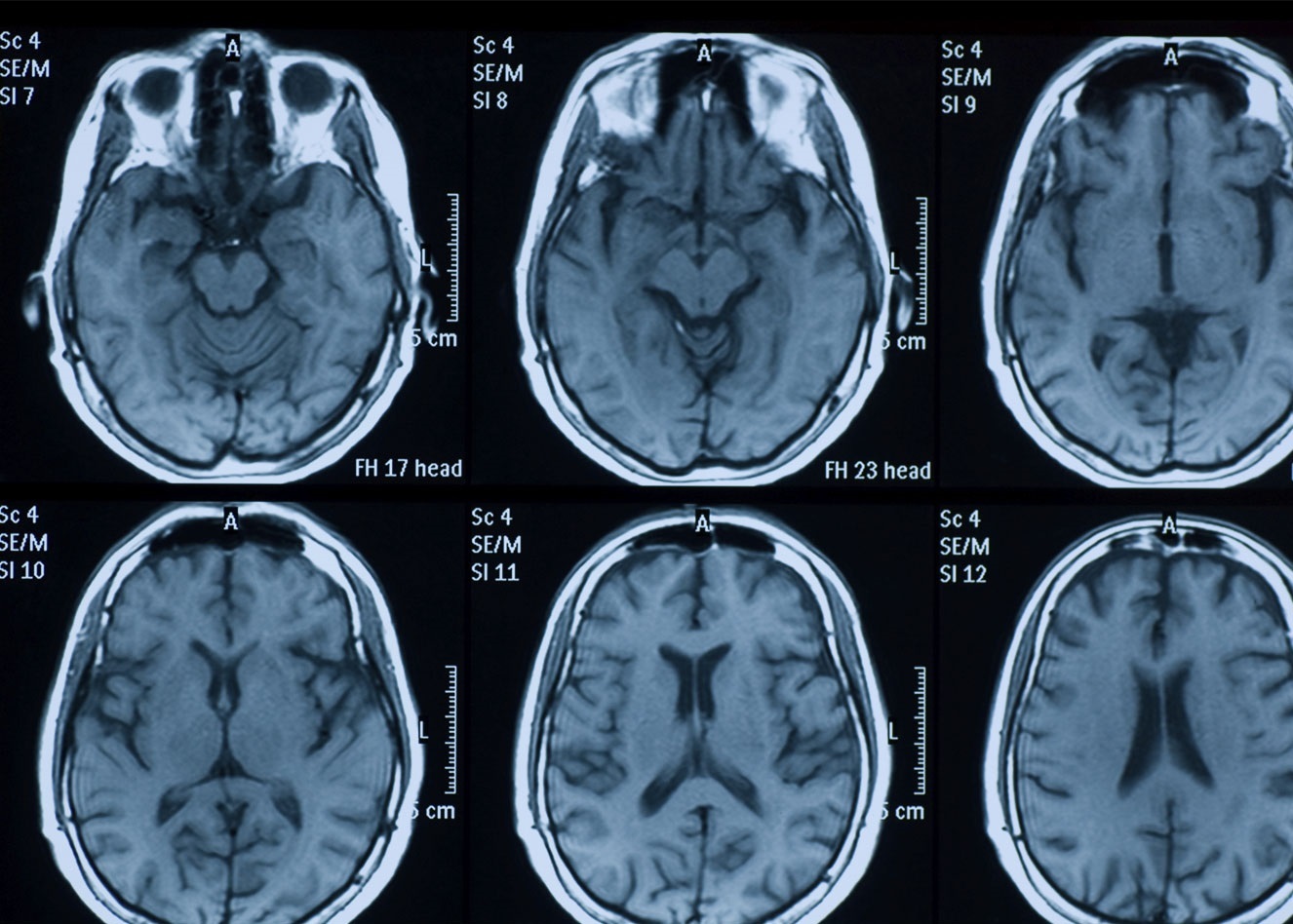 تصویربرداری از مغز بیمار