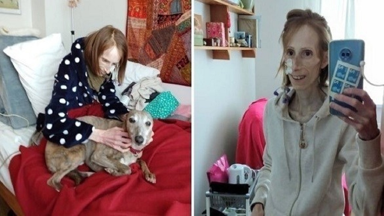 بیماری که بدنش دائماً کوچک میشود +تصویر