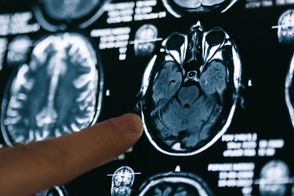 پژوهشگران از تغییرات مغزی «قابل توجه» پس از ابتلای خفیف به کرونا خبر می‌دهند