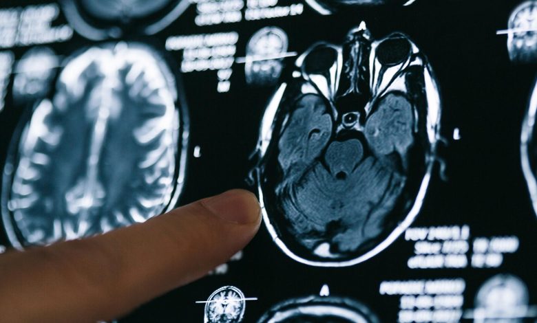پژوهشگران از تغییرات مغزی «قابل توجه» پس از ابتلای خفیف به کرونا خبر می‌دهند
