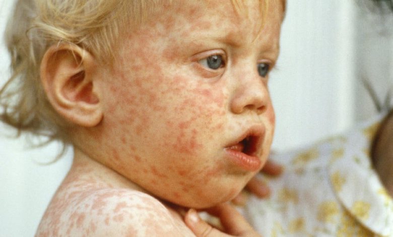 هشدار یونیسف و سازمان بهداشت جهانی به افزایش 80 درصدی ابتلا به سرخک در سراسر جهان