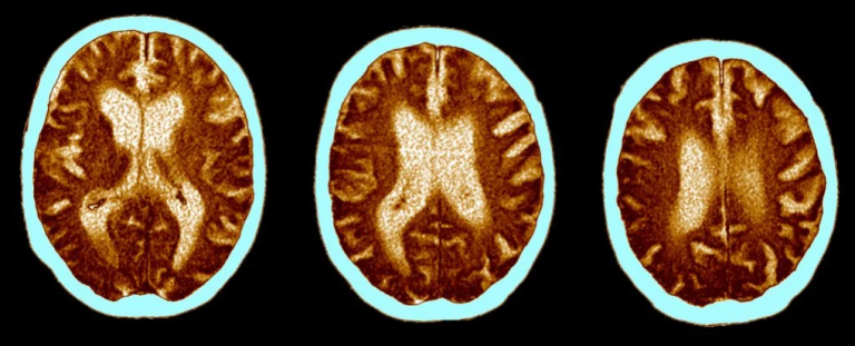 ابتلا به کرونای حاد معادل ۲۰ سال مغز را پیر می‌کند