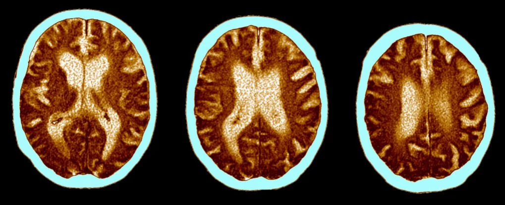 ابتلا به کرونای حاد معادل ۲۰ سال مغز را پیر می‌کند