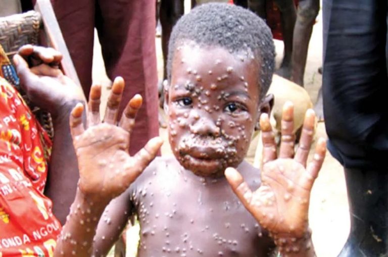 سازمان بهداشت جهانی: شیوع آبله میمون قابل کنترل است