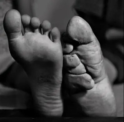 عکس | شکستن استخوانهای پا به اسم زیبایی؛ دردناکترین سنت جهان!