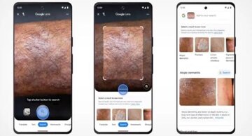 تشخیص بیماریهای پوستی با گوگل لنز و هوش مصنوعی/ عکس