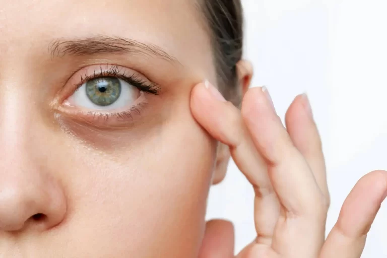 علت سیاهی زیر چشم چیست و چگونه درمان می شود؟