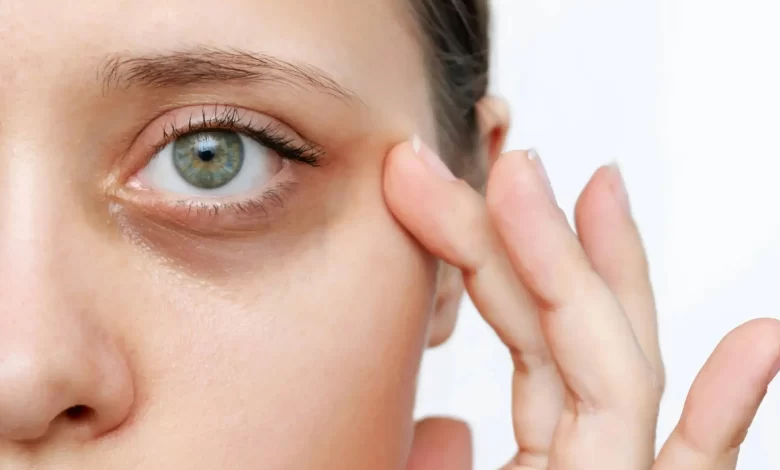 علت سیاهی زیر چشم چیست و چگونه درمان می شود؟