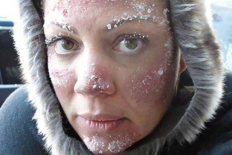 سرمازدگی چیست و چگونه با آن مقابله کنیم؟