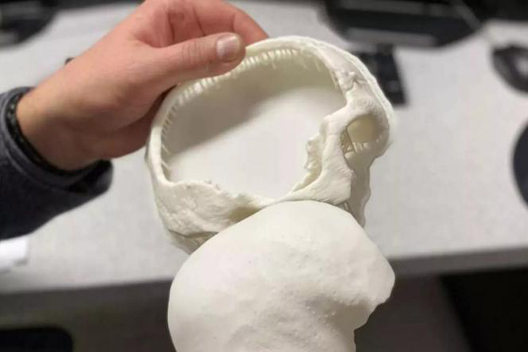 جمجمه تولید شده با چاپگر سه‌بعدی جان پسربچه ۱۰ ساله را نجات داد