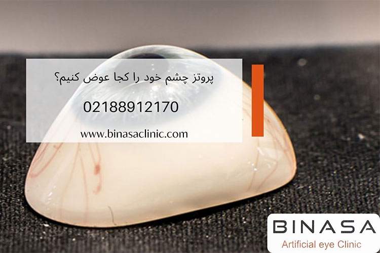 پروتز چشم خود را کجا تعویض کنیم؟