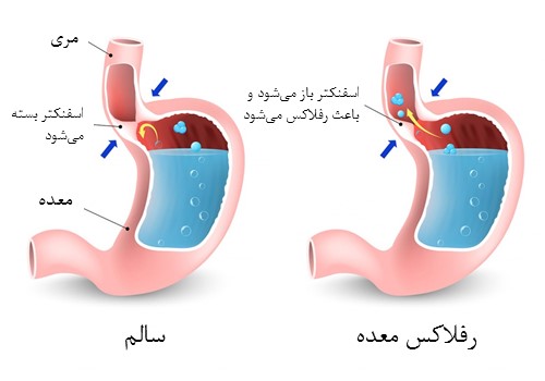 رفلاکس معده چگونه به وجود می آید؟