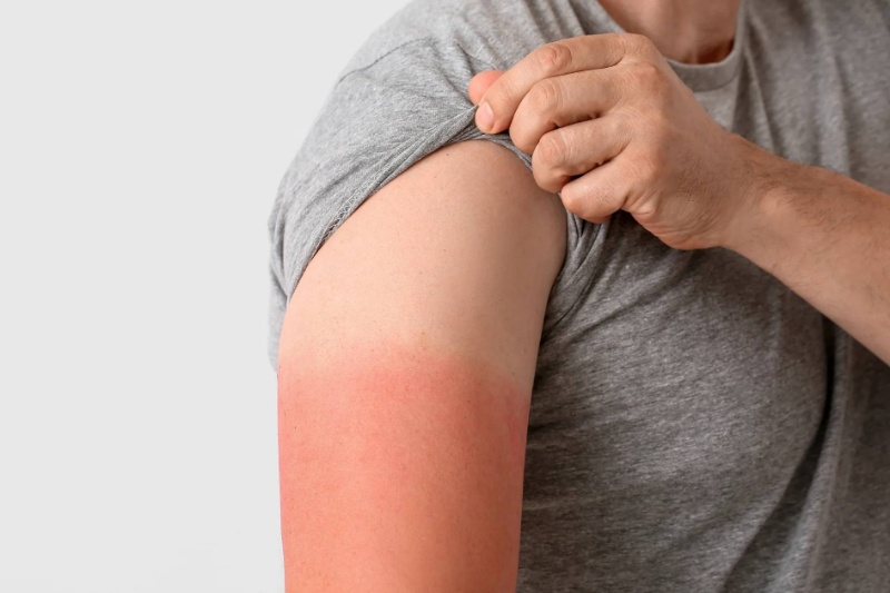 دانشمندان میگویند درباره علت آفتابسوختگی اشتباه میکردند