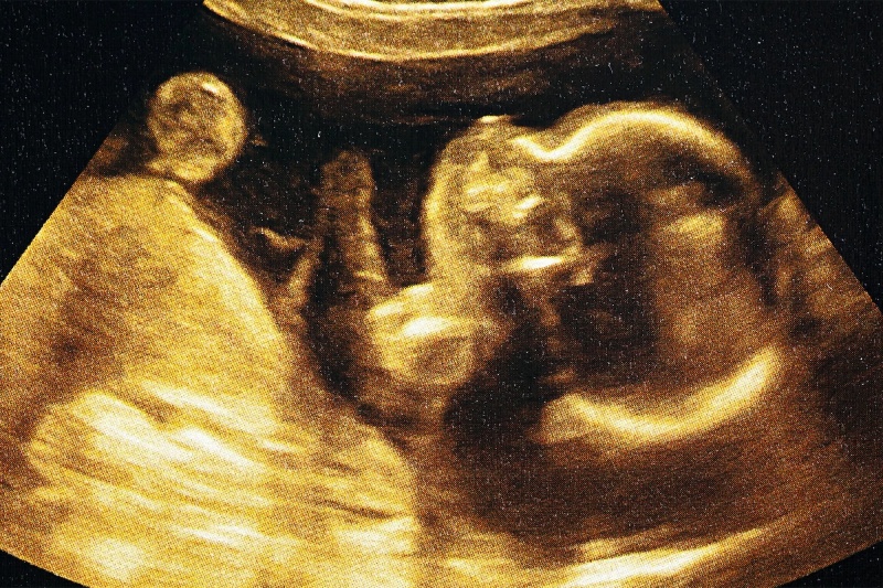 دستاورد بیسابقه پزشکان: درمان بیماری مرگبار یک جنین پیش از تولد