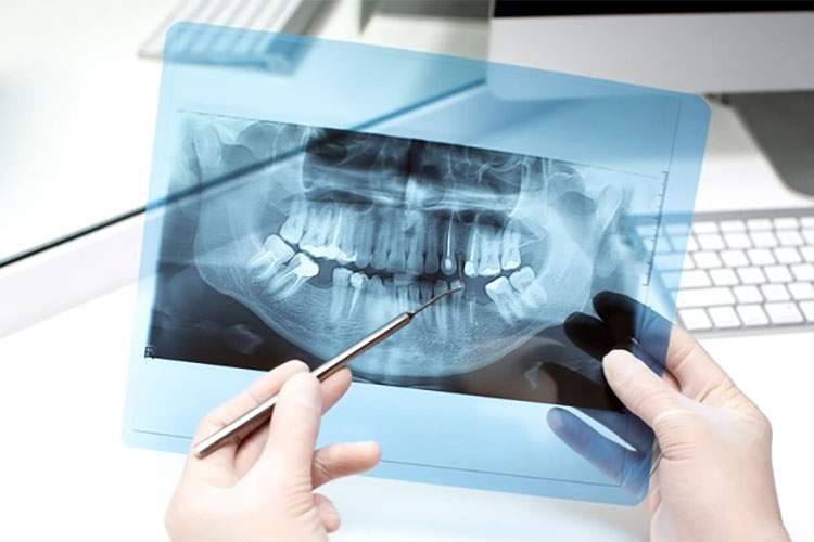 عوارض اشعه رادیوگرافی دندانپزشکی