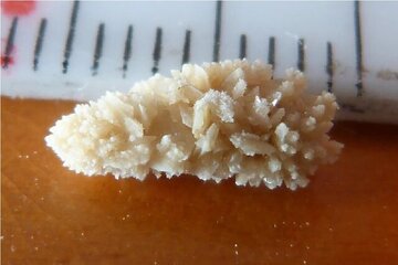 دفع بدون درد سنگ کلیه با یک ربات کوچک