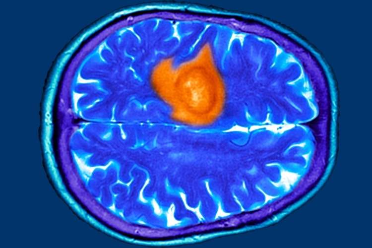 هفت نشانه پنهان تومور مغزی که ممکن است آن‌ها را عادی بپندارید