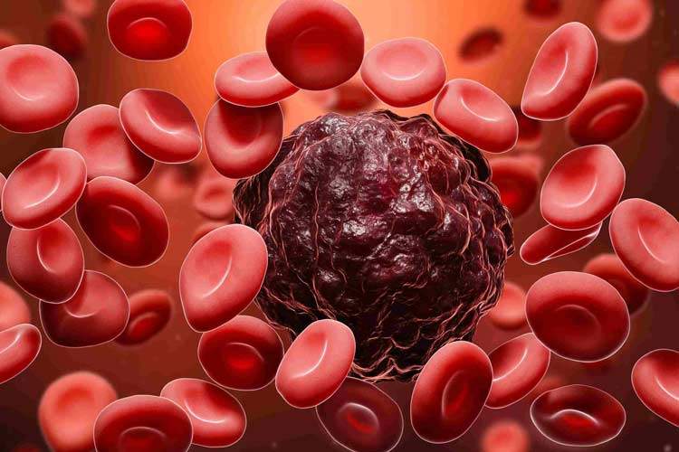 روش جدید نوردرمانی در نیم ساعت، ۹۰ درصد از سلول‌های سرطانی را از بین می‌برد