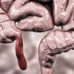 پژوهشگران از افزایش شیوع سرطانی نادر در جوانان خبر می‌دهند