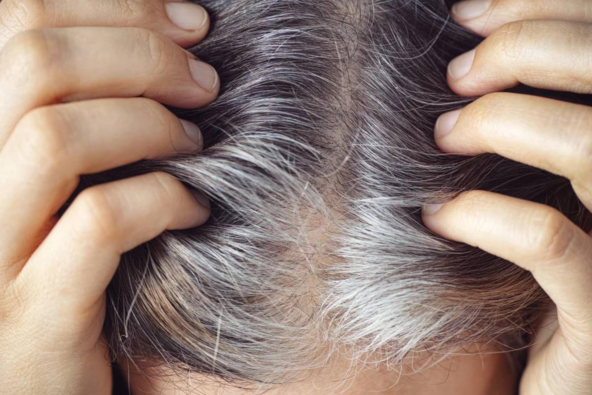 خاکستریشدن موها احتمالاً رویکرد طبیعی بدن برای مقابله با سرطان است